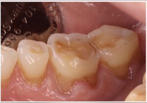 Dental Erosion Molars