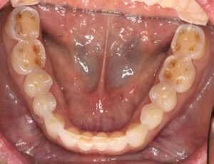 Dental Erosion Lower